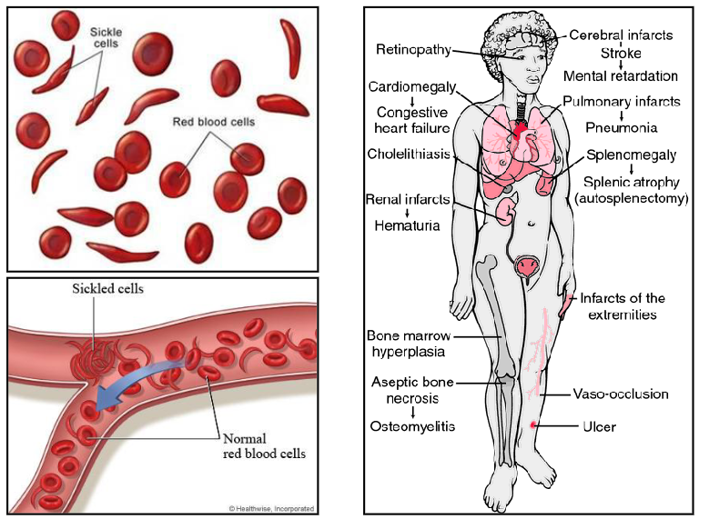 <p>Sickle Cell Disease Diagram</p>