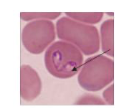 <p>What does this blood smear micrscopy indicate?</p>