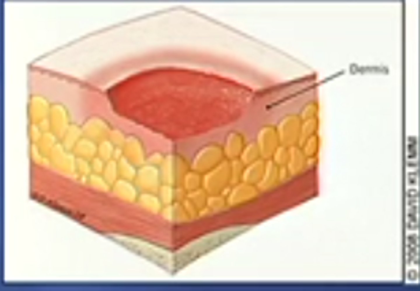 <p>partial thickness loss of skin with exposed dermis</p><p>-ulcer, blister, abrasion</p>