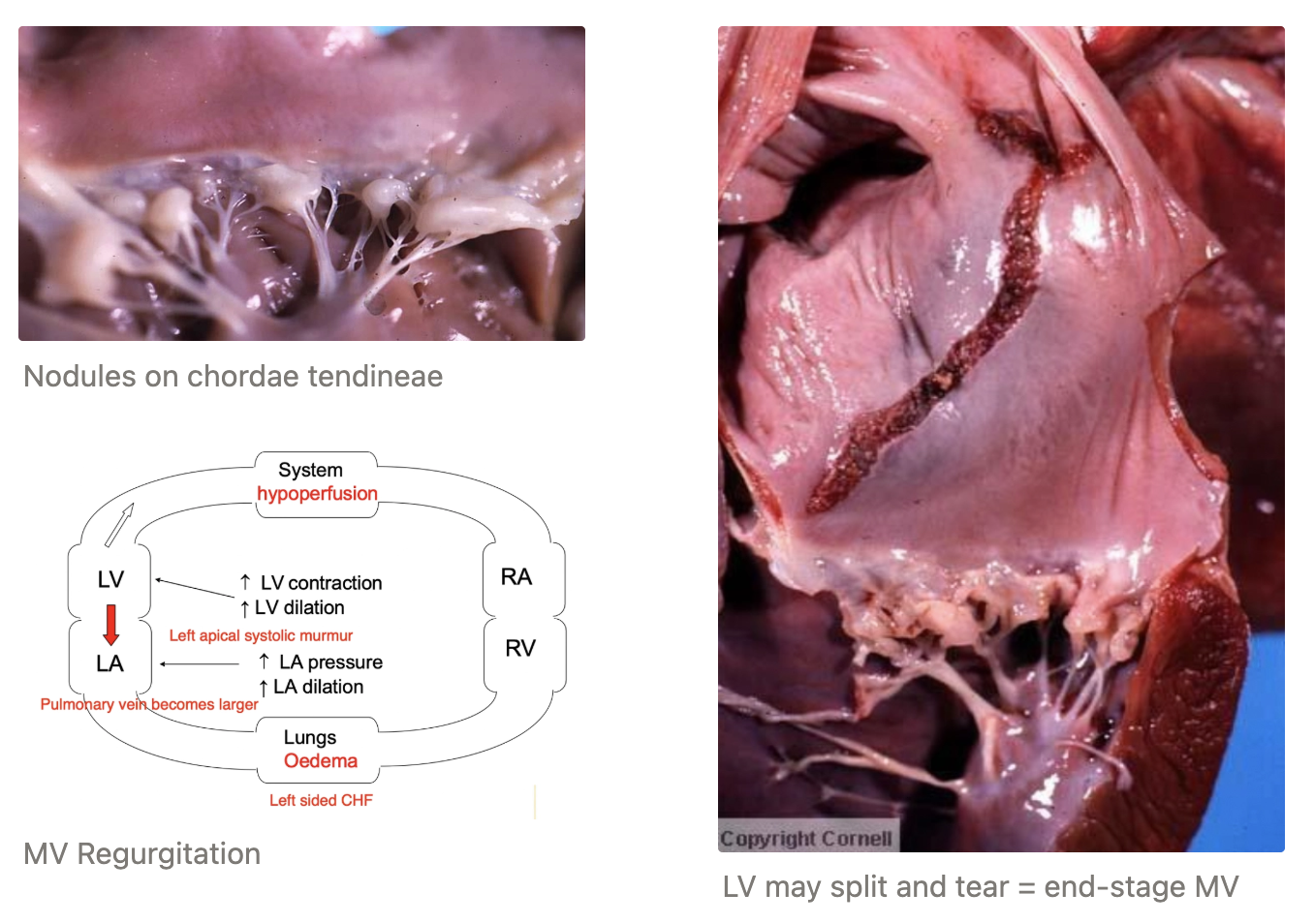 <p><u>Prevalence:</u> #1 heart disease of dogs (75%)</p><ul><li><p>Common incidental finding at necropsy</p></li></ul><p><u>Valves:</u> MV only = 60%, MV and TV = 30%, TV only = 10%</p><ul><li><p>Usually MV precedes TV due to larger circulatory bed</p></li></ul><p><u>Signalment:</u></p><ul><li><p><strong>Breed</strong> = Small - medium dogs</p><ul><li><p>CKCS (>50% by 4yr and almost 100% by 10yr)</p></li><li><p>Dachshund, poodle, JRT, Yorkie, Chihuahua</p></li><li><p>Unusual in large breeds (but associated with more rapid CHF)</p></li></ul></li><li><p><strong>Sex</strong> = Male > Female</p></li><li><p><strong>Age</strong> = Middle-aged to older</p></li></ul><ul><li><p>Uncommon in cats</p></li></ul><p><u>Aetiology:</u> Non-inflammatory, degenerative process AND hereditary with complex inheritance pattern</p><p><u>Pathogenesis:</u></p><ol><li><p>Abnormal collagen degeneration/remodelling (often associated with collapsing airways)</p><ul><li><p>Loose fibroblastic tissue in spongiosa of valve</p></li><li><p>Deposition of HA and chondroitin sulphate</p></li><li><p>Collagen degeneration of valvular fibrosa and chordae tendinae</p></li></ul></li><li><p>Valve laxity and prolapse</p></li><li><p>Valve becomes thickened and nodular due to scar tissue → Prevents valve from forming tight seal → Regurgitation</p></li><li><p>Chordae tendinae thicken and may rupture</p></li><li><p>Cardiac remodelling = Eccentric hypertrophy due to volume overload</p></li><li><p>Ventricle MAY split</p></li></ol><p></p>