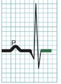 <p>Ventricular systole (contraction)</p>
