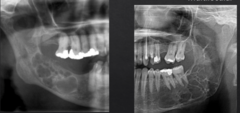 <p>How are these lesions described in terms of internal structure?</p>