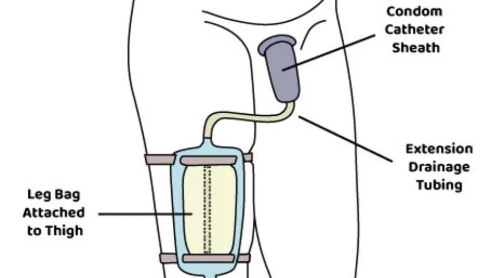 <p>What is a condom catheter (Texas catheter), and what caution is required during therapy?</p>