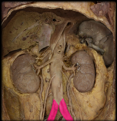 <ul><li><p><strong>Origin: </strong>Abdominal aorta</p></li><li><p><strong>Course: </strong></p><ul><li><p>Begins anterior to L4 vertebral body</p></li><li><p>Passes obliquely across L4-5 vertebral bodies</p></li><li><p>Ends at the level of the sacro-iliac joint (L5-S1)</p></li></ul></li><li><p><strong>Distribution: </strong>Pelvis, Posterior abdominal wall, Perineum, and Lower limb</p></li><li><p><strong>Branches: </strong>Internal iliac and External iliac</p></li></ul><p></p>
