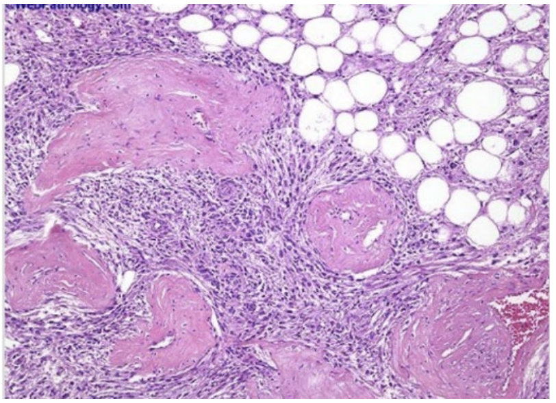 <p>A 35-year-old female is brought to the emergency department in hypovolemic shock, after sudden onset of severe left flank pain. Physical examination reveals a tender, palpable mass in the left upper abdomen. Abdominal CT scan demonstrates a large renal mass and evidence of retroperitoneal hemorrhage.The patient has a long-standing history of seizures since childhood and multiple hypopigmented “ash-leaf” macules on her trunk. Family history is notable for a brother with intellectual disability. On examination, she is also found to have multiple small reddish papules over the nose and cheeks. The patient undergoes emergent nephrectomy. Gross examination reveals a variegated tumor containing adipose tissue, thick-walled blood vessels, and smooth muscle bundles. The microscopic specimen from surgery is shown in the attached photo. This patient is most likely at increased risk for developing which of the following additional findings?</p>