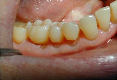<p>Microfracture of the tooth what is this?</p>