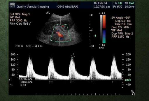 <p>What is the principal ultrasound criterion for renal artery stenosis?<br>→ Velocity flow jets/elevated PSV</p><p>Why is a careful Doppler survey important?<br>→ Identify maximum flow velocity</p><p>What does aliasing commonly suggest in renal arteries?<br>→ High velocity stenotic flow</p>