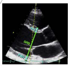 <p>IVS- Interventricular septum</p><p>LVID- LV inner diameter</p><p>PWT- posterior wall thickness</p><p>Measured in end diastole</p>