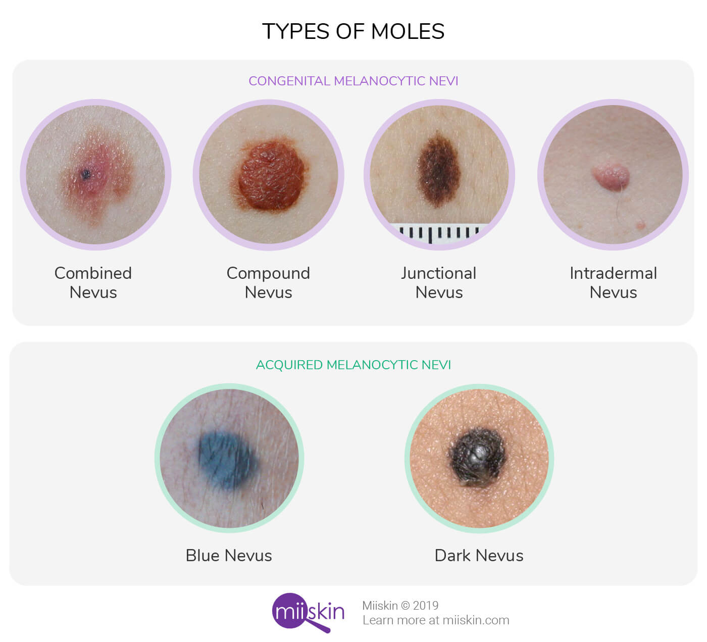 <p>A benign growth or lesion made up of melanocytes or other skin cells.</p>