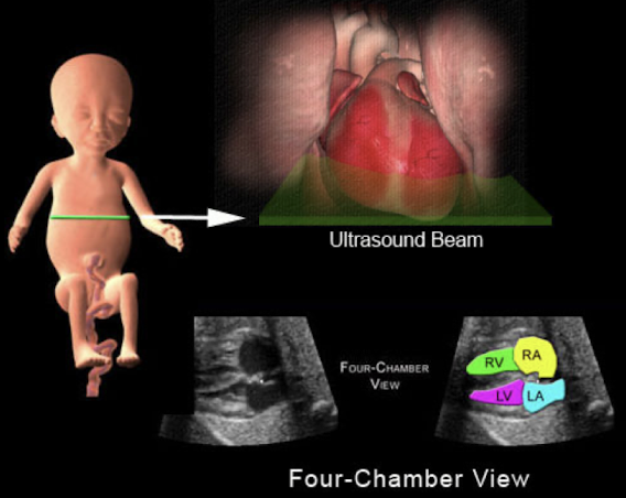 <ul><li><p>obtained from TRV view of abdomen just above diaphragm</p></li><li><p><span style="color: red;">make sure to have ribs on both sides during 4CH view</span></p><ul><li><p>must see ribs on both sides to be true TRV rather than oblique</p></li></ul></li><li><p><span style="color: red;">heart takes up 1/3rd of chest</span></p></li><li><p>heart angles 45 degrees to the left</p></li><li><p>always make sure the heart is beating</p></li></ul><p></p>