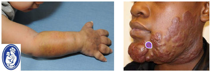 <ul><li><p>uncommon errors on vascular morphogenesis</p></li><li><p>distinct from hemangioma</p></li><li><p>not a neoplasm</p></li><li><p>present at birth but may not clinically evident </p></li><li><p>consist of abnormal channels lined by normal endothelium</p></li><li><p>classified as arterial, venous, capillary, lymphatic, or combinations </p></li></ul><p></p>