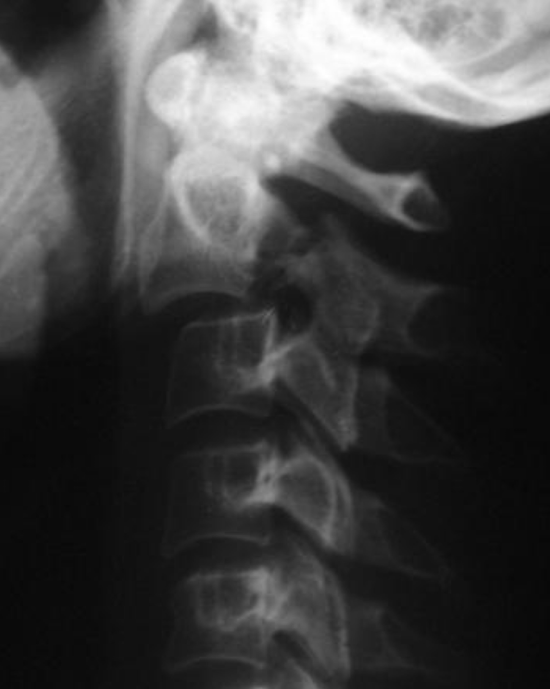 <p>Bilateral fracture through the pedicles due to hyperextension</p>