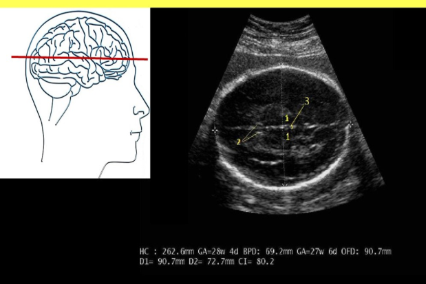 <p>Label the BPD intracranial anatomy</p>