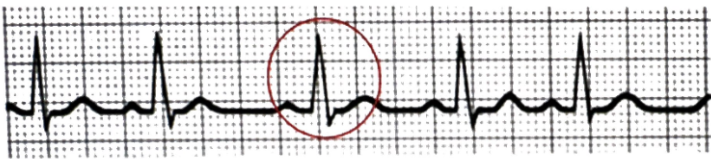 <p>Normal sinus P waves, but R-R intervals vary</p>