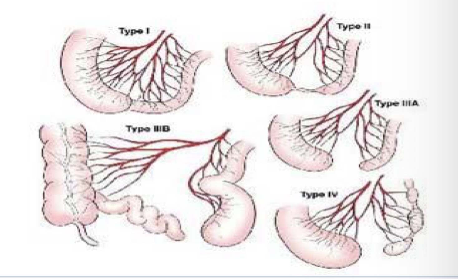 <ol><li><p>Membranous obstruction of lumen </p></li><li><p>Thin fibrous with no mesenteric defect </p></li><li><p>Multiple atresia (string of sausages) </p></li><li><p>Large mesenteric / apple-peel </p></li></ol><p></p>
