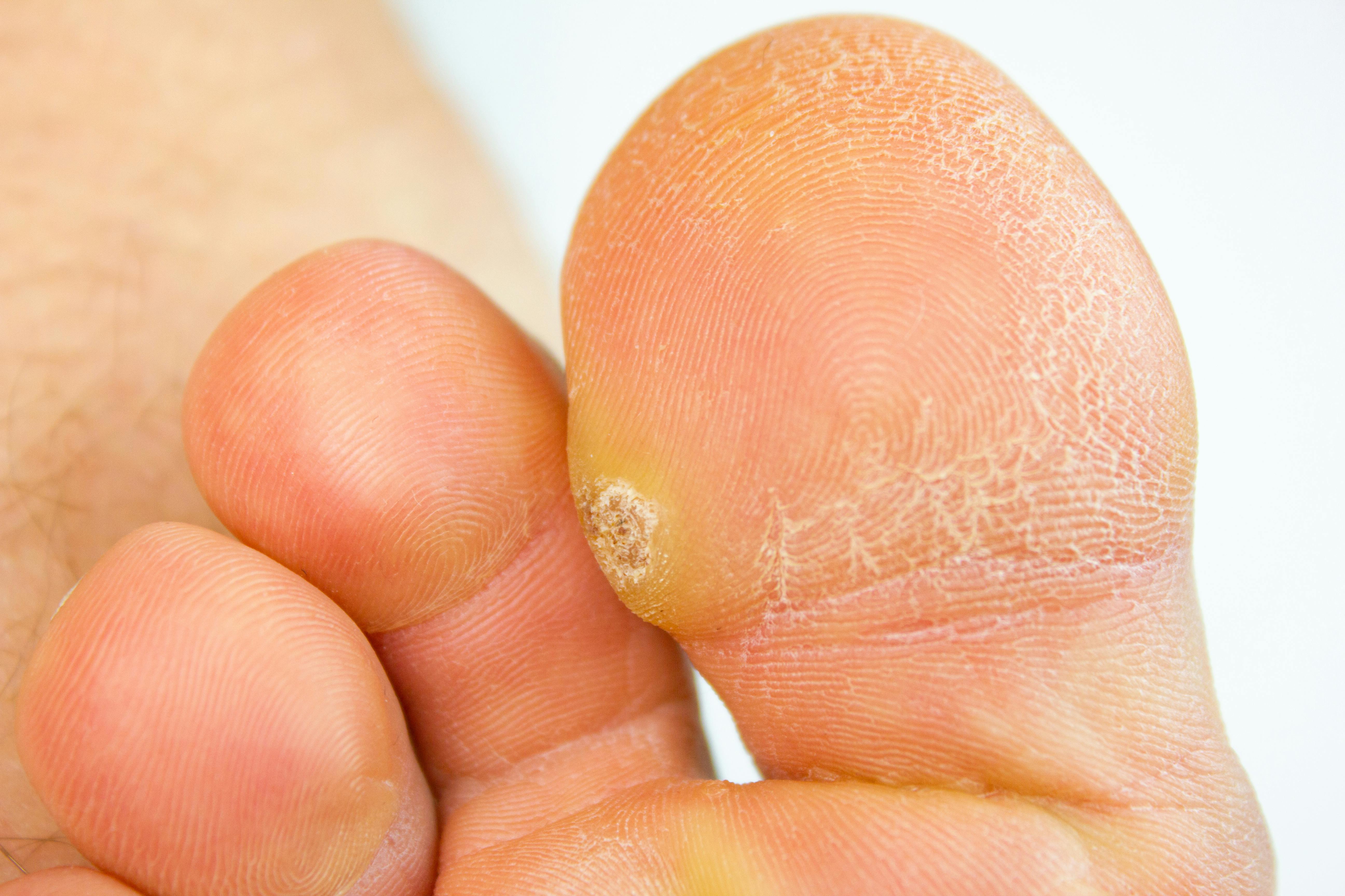 <p>On the soles of the feet.</p>