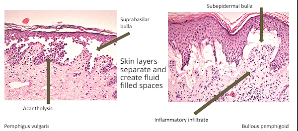<ul><li><p><span style="color: red;"><strong>Subepidermal bullae </strong></span>(blisters forms beneath epidermis) or<span style="color: red;"> <strong>Intraepidermal bullae</strong></span> (blister forms within epidermis)</p></li><li><p>Some related VD diseases may have <strong>acantholysis</strong> (separation of keratinocytes) or <strong>hyperkeratosis</strong></p></li><li><p>Inflammatory infiltrate within dermis and around blister can vary, commonly including<strong> Eosinophils, neutrophils and lymphocytes</strong></p></li></ul><p></p>