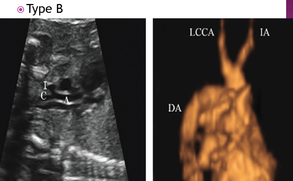 <p>50% association with digeorge syndrome </p>