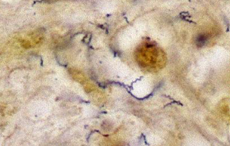 <p>treponema pallidum (syphilis + chancre) class? characteristic? symptoms? treatment?</p>