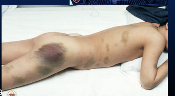 <p>Bruising commonly associated with coagulation disorders. (>1 cm)</p>