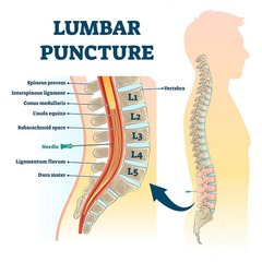 <p>Procedure performed at L3-L4 to avoid spinal cord injury.</p>