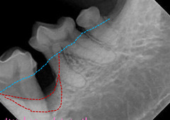 <p>What pattern of bone loss is this?</p>