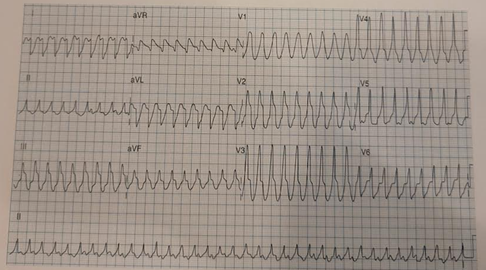 <p>howd yk this is v tach</p>