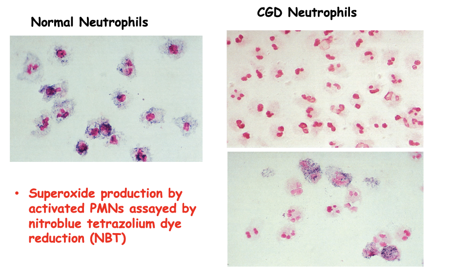 <p><span>• Mutation in gp91 (x-linked CGD)<br>• Mutation in p47 (autosomal recessive)<br>• characterized by recurrent life-threatening infections, hypergammaglobulinemia and tissue granuloma formation.<br>• Infections are most commonly pneumonia, lymphadenitis, liver abscess, skin abscess, perianal abscess, and osteomyelitis.</span></p><p><span>Superoxide production by activated PMNs assayed by</span><br><span>nitroblue tetrazolium dye reduction (NBT)</span></p>