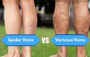 <p>swollen, twisted veins (typically in legs) caused by weakened valves (blood flows backward &amp; collects in the veins)</p>