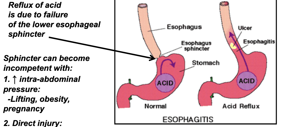 <p>esophageal sphincter</p>