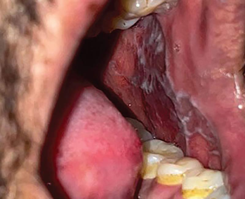 <p>Mouth and other mucous membranes; it can also affect nails, scalp, and genital areas</p>