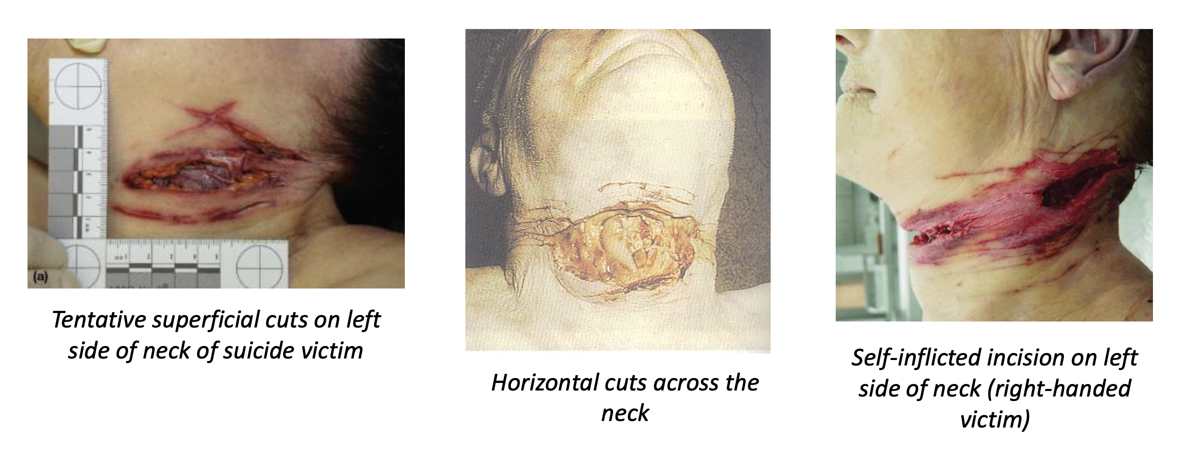 <p><strong>General:</strong></p><ul><li><p>Neck incisions are usually <strong>suicidal or homicidal</strong>, <strong>rarely accidental</strong>.</p></li></ul><p class="isSelectedEnd"><strong>Typical features of suicidal cuts:</strong></p><ul><li><p>Often begin on the <strong>opposite side of the dominant hand</strong></p><ul><li><p>e.g., <strong>right-handed person → cut starts on left side of neck</strong></p></li></ul></li><li><p><strong>Deeper at the origin</strong> and <strong>tails off</strong> as the cut progresses</p></li><li><p>May appear <strong>horizontal, linear, and clean</strong></p></li></ul><p class="isSelectedEnd"><strong>Other indicators:</strong></p><ul><li><p><strong>Tentative/hesitation wounds</strong> (multiple shallow cuts nearby)</p></li><li><p><strong>Deep incisions</strong> may sever <strong>hyoid bone and thyroid cartilage</strong> and leave <strong>marks on vertebrae</strong></p></li></ul><p class="isSelectedEnd"><strong>Possible causes of death:</strong></p><ul><li><p><strong>Asphyxiation</strong></p></li><li><p><strong>Exsanguination (severe blood loss)</strong></p></li><li><p><strong>Air embolism</strong></p></li></ul><p></p>