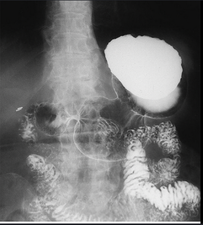 <p>What projection is this? (barium in fundus)</p>