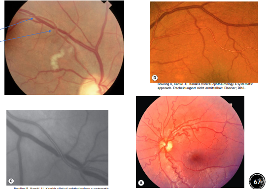 <ul><li><p>Arterial attenuation</p></li><li><p>Copper wiring</p></li><li><p>AV nicking (Picture)</p></li><li><p>Venous tortuosity</p></li><li><p>Optic disc edema</p></li></ul><p></p>