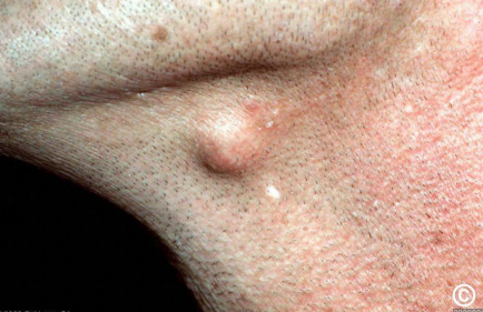 <p>A 35 year presented with cystic swelling on left side of the neck of 2 cm diameter. Provide DD</p>