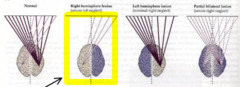 <p>Failure to respond to or be aware of stimuli on the side of space opposite a brain lesion.</p>