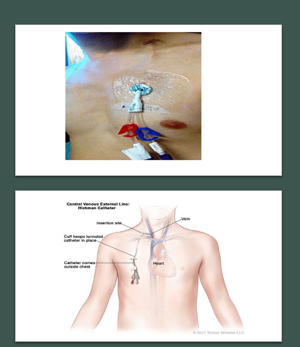 <p>implanted IV catheter into jugular vein for long-term use</p>