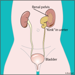<p>tắc niệu quản </p><p>the ureter carries urine from the kidney to the bladder</p>