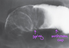 <p>Telescoping of one part of the intestinal tract into another because of peristalsis</p><ul><li><p>Common in children</p></li><li><p>Air-filled “coiled spring” appearance</p></li></ul><p></p>