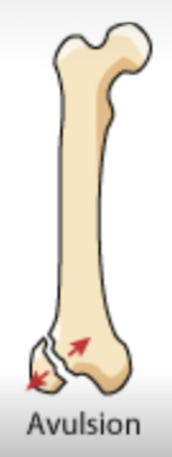<p>fragment of bone is separated from main mass</p>