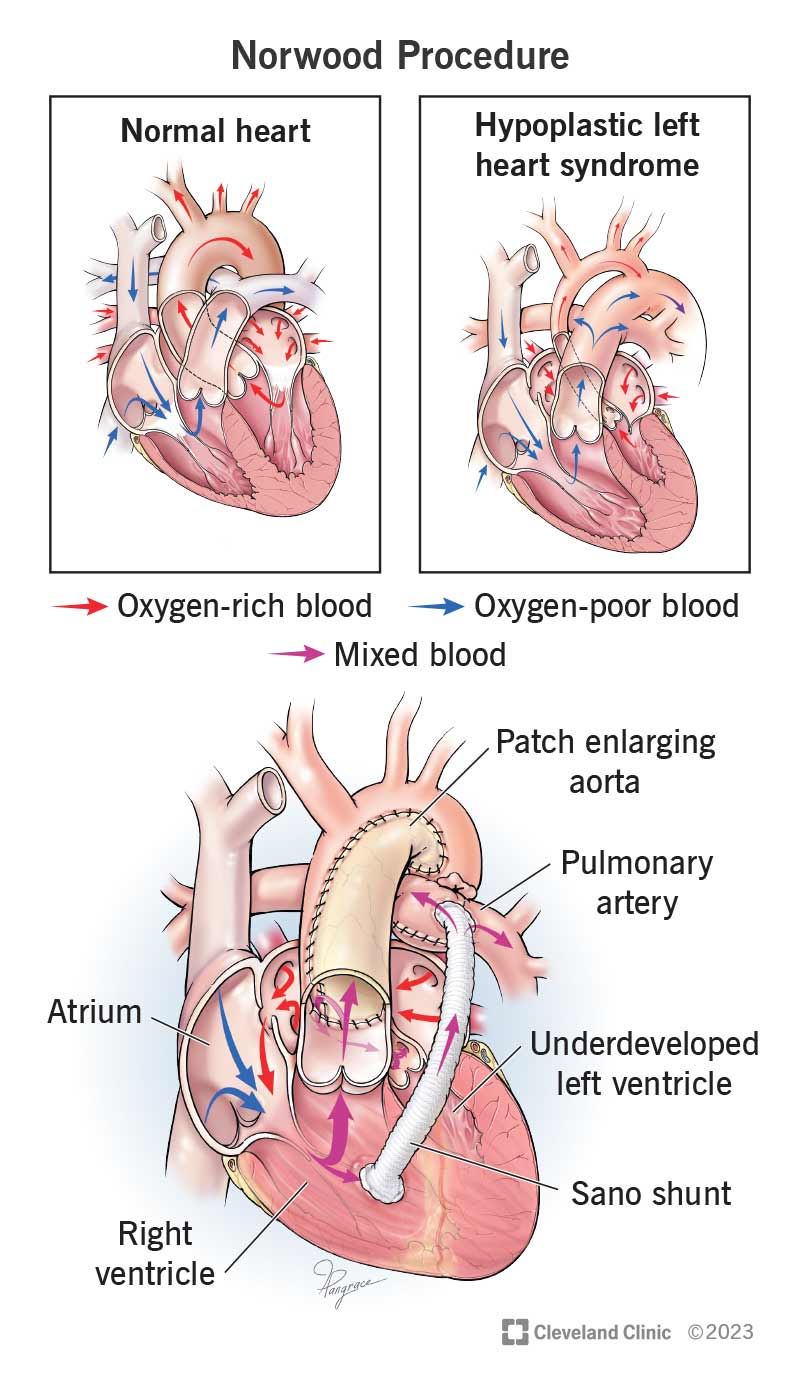 <p>norwood procedure</p>