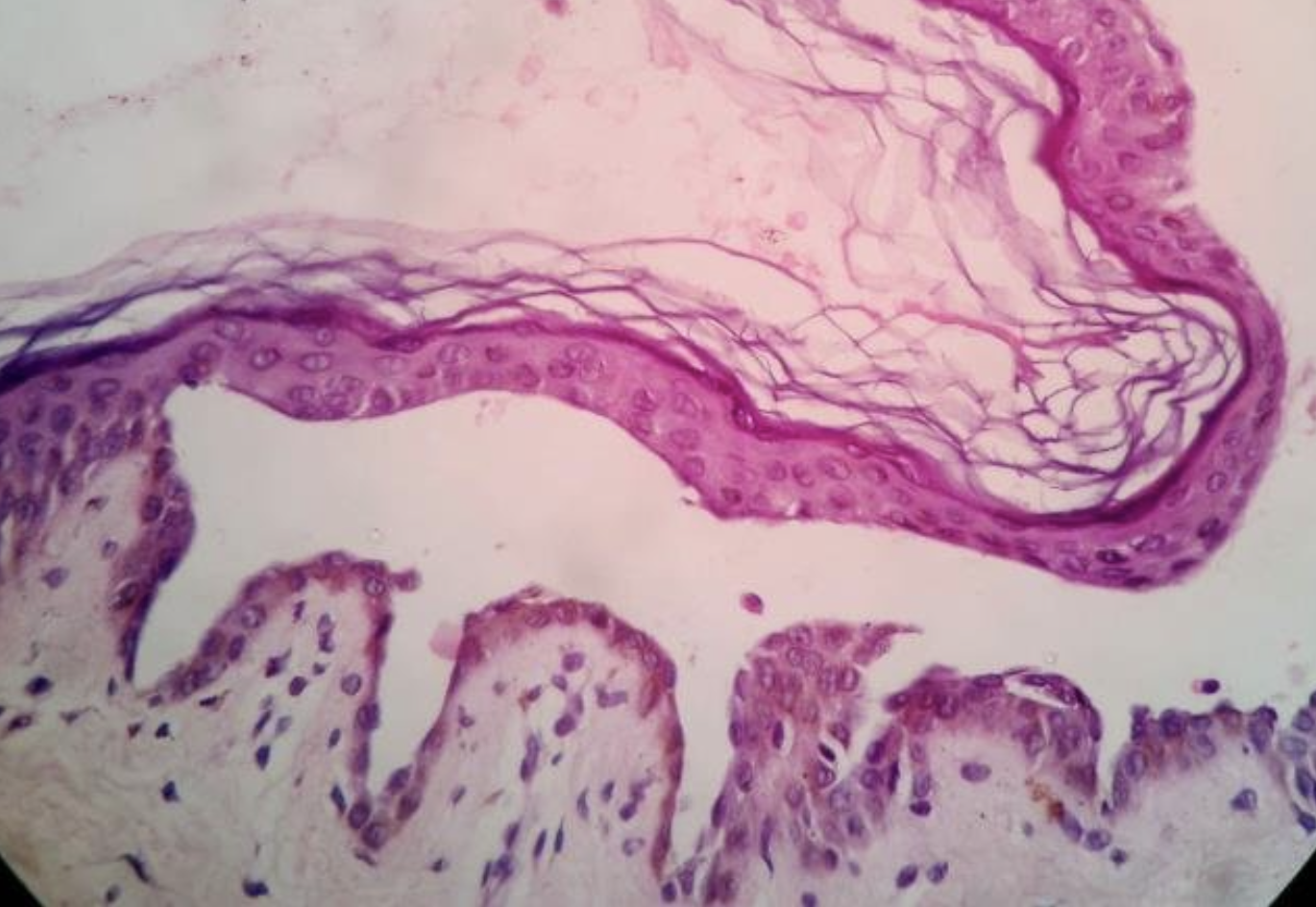<p>Feline Pemphigus Vulgaris</p>
