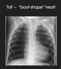 <p>Eval:</p><p>- Echo (mainstay)</p><p>- ECG w/ RVH</p><p>- CXR w/ boot-shape heart</p><p>Tx: </p><p>PGE1 (prostaglandins): to keep PDA since pulmonary stenosis is severe</p><p>surgery</p>