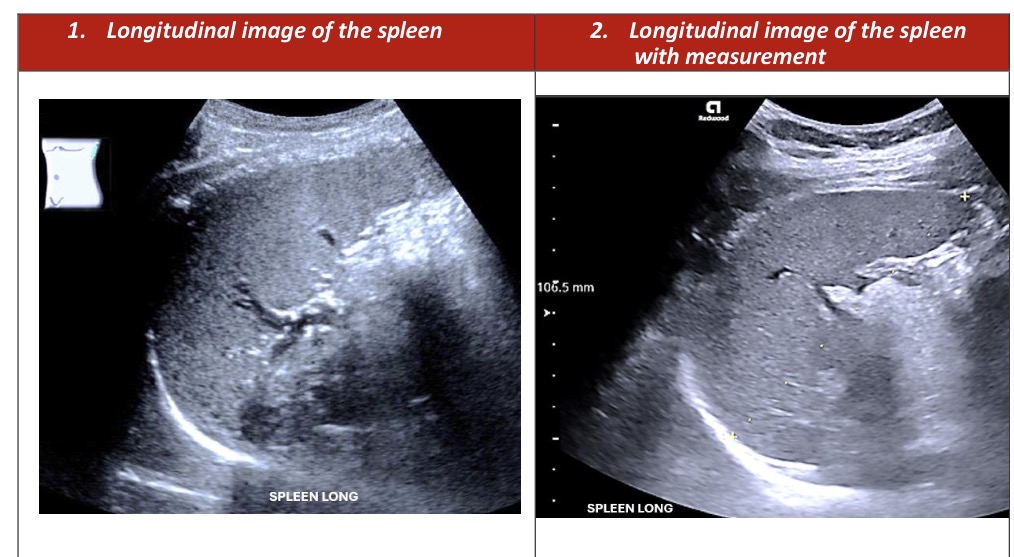 <p>Spleen Longitudinal Survey</p>