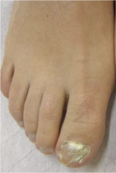 <p>Physical examOnychomycosis</p>