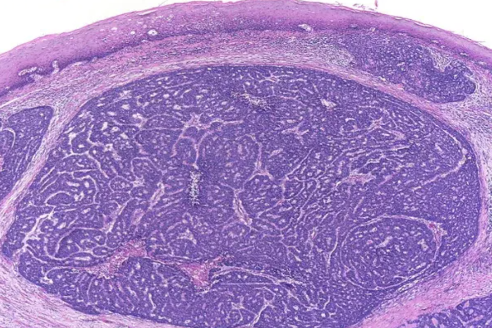 <p>Tumeur de l’oesophage </p><p>1) Diagnostic</p><p>2) Histologie</p>