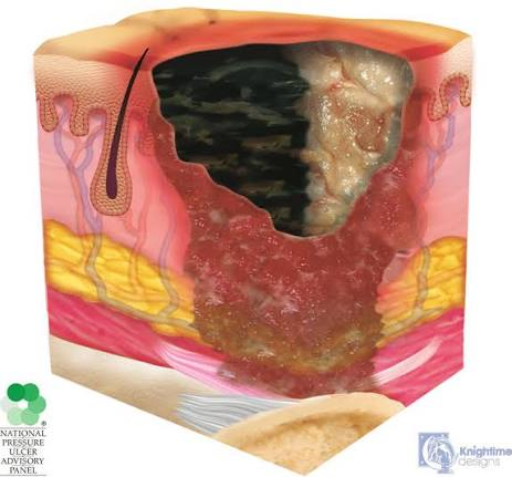 <p><strong>Correct Answer: C</strong></p><p><strong>Rationale:</strong> A pressure injury is <strong>unstageable</strong> when slough or eschar obscures the wound, preventing confirmation of the depth of tissue loss</p>