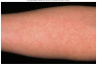 <p><strong><mark data-color="blue" style="background-color: blue; color: inherit;">Viral</mark></strong><mark data-color="blue" style="background-color: blue; color: inherit;"> skin disease</mark></p><p><strong><mark data-color="purple" style="background-color: purple; color: inherit;">[__]</mark></strong><mark data-color="purple" style="background-color: purple; color: inherit;">:</mark> also known as German measles, is a mild illness </p><p>but also <strong>harmful to fetuses</strong> their first summer</p><p><mark data-color="yellow" style="background-color: yellow; color: inherit;">→ causes defects in eye, heart, and brain damage in fetus if mother is infected</mark></p><p>→ results in spontaneous abortion; why women test for immunity against Rubella</p><p>» when antigens and antibodies bind, <mark data-color="yellow" style="background-color: yellow; color: inherit;">antigen-antibody complex can cause for inflammation and  rash and joint pain</mark></p><p><u><mark data-color="blue" style="background-color: blue; color: inherit;">Causative agent</mark></u>: <strong><mark data-color="purple" style="background-color: purple; color: inherit;">[__] virus</mark></strong></p><p><u><mark data-color="blue" style="background-color: blue; color: inherit;">Spread</mark></u>: <mark data-color="purple" style="background-color: purple; color: inherit;">respiratory droplets</mark></p><p><u><mark data-color="blue" style="background-color: blue; color: inherit;">Pathogenesis</mark>:</u> transmitted into the <mark data-color="purple" style="background-color: purple; color: inherit;">respiratory route </mark></p><p>» multiplies and get send to the bloodstream <strong>(viremia</strong>) and affects body tissues</p><p>» can cross placenta and affect fetuses</p><p><u><mark data-color="blue" style="background-color: blue; color: inherit;">Prevention</mark>:</u> <strong><mark data-color="purple" style="background-color: purple; color: inherit;">Attenuated rubella virus vaccine (MMR)</mark></strong></p>
