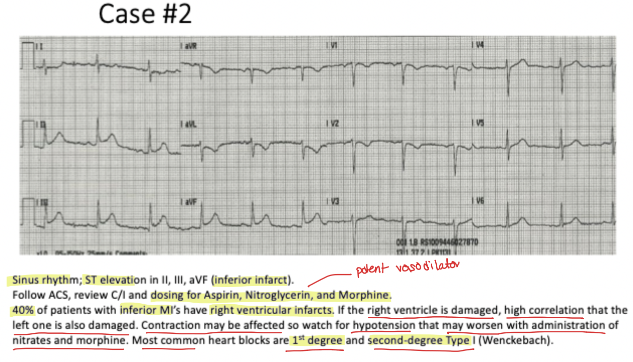 <p><strong>Inferior Wall MI</strong></p>