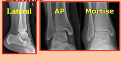 <p>Ankle Routine projections?</p>